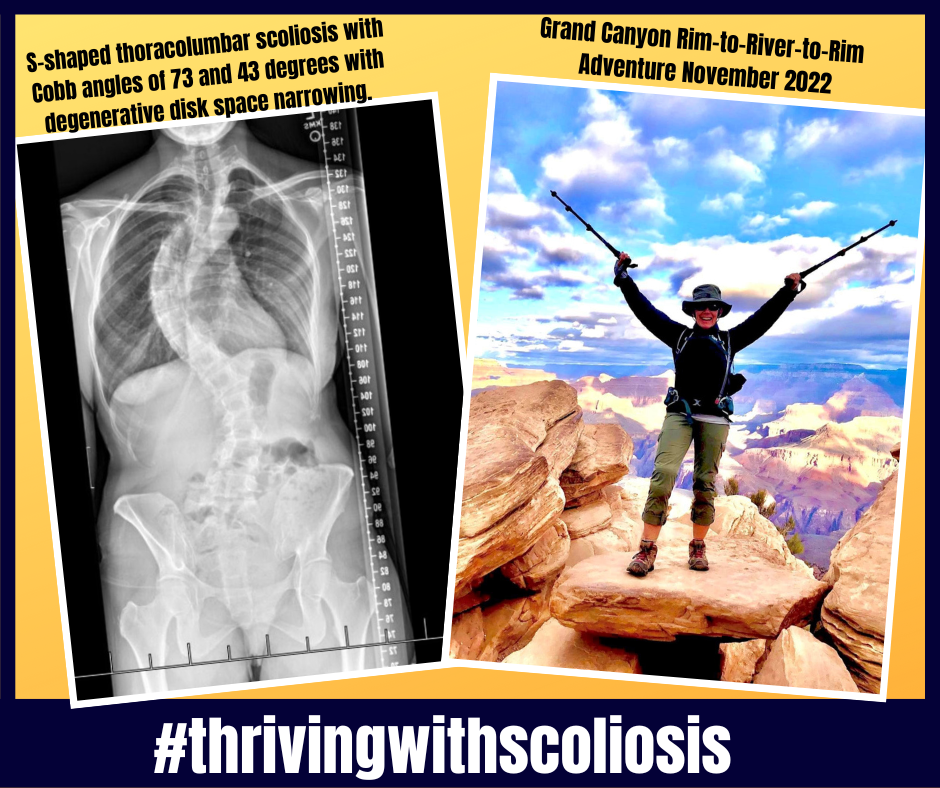 #ThrivingWithScoliosis!