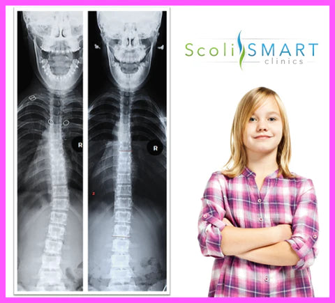 Scoliosis Causes: A Complete Understanding