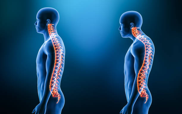 Kyphosis and Scoliosis: What's the Connection?