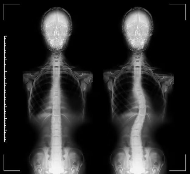 Understanding How X-Rays Aid in Scoliosis Diagnosis